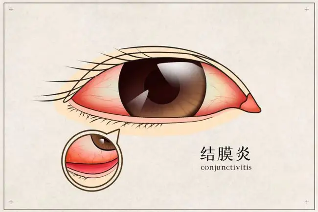 皮膚癢、拉肚子、腸胃不適、感冒，春夏換季病，艾灸來(lái)搞定！